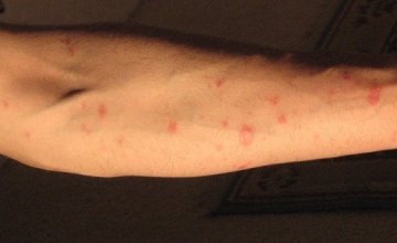 pityriasis-rosea