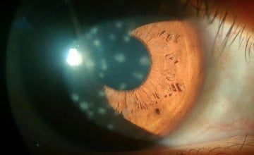 keratitis