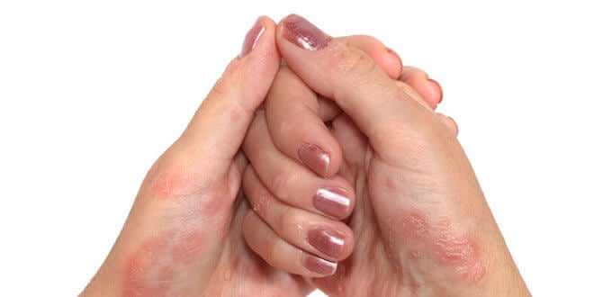 psorijaza