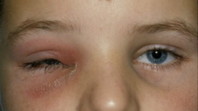celulitis