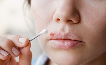 Herpes na usni