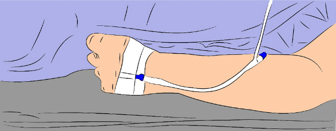 Infuzija